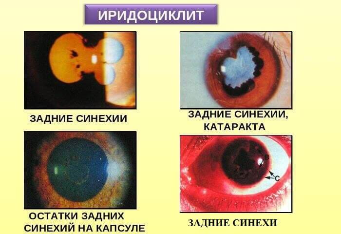 Задние синехии