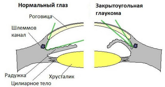 Закрытоугольная глаукома глаза