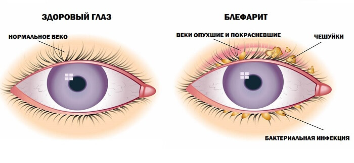 Здоровый глаз и блефарит