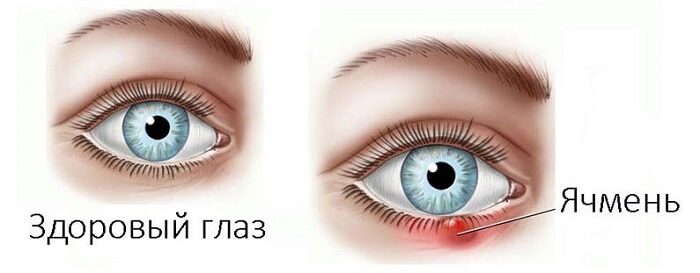 Здоровый глаз и ячмень