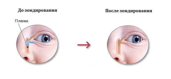 Зондирование слезного канала